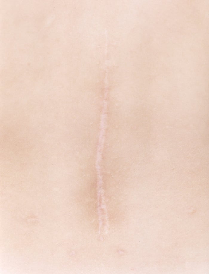 Close-up of a healed surgical scar on skin showing natural texture and healing process