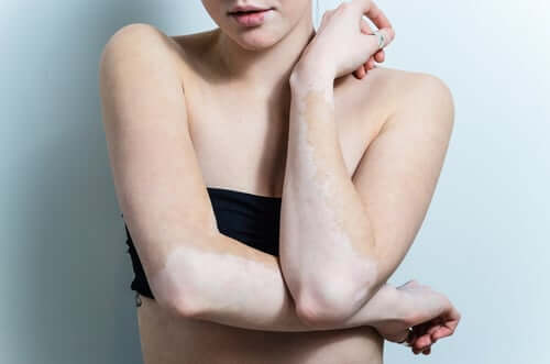 Woman with vitiligo showing white patches on arms and torso against clean white background