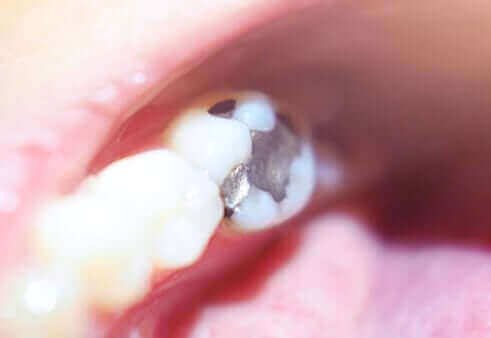 Curcumin-infused dental resin provides long-lasting antibacterial protection