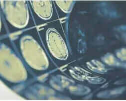 Discussing Stroke And Resveratrol