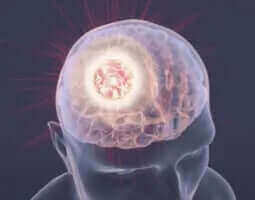 Brain Cancer, Arthritis And Resveratrol