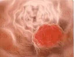 Resveratrol on Aggressive Tumor