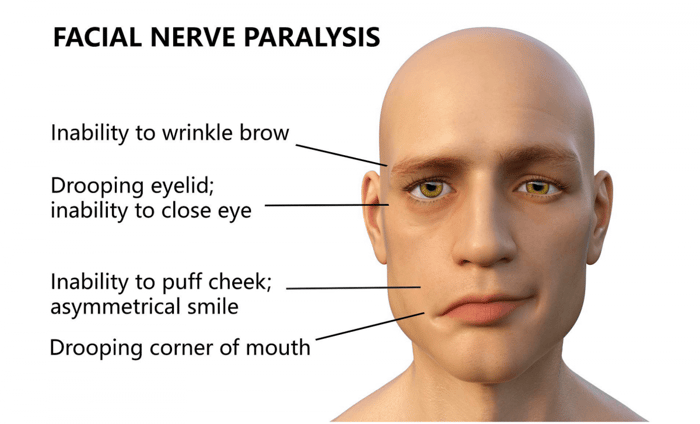 EMS Unit for Bell's Palsy