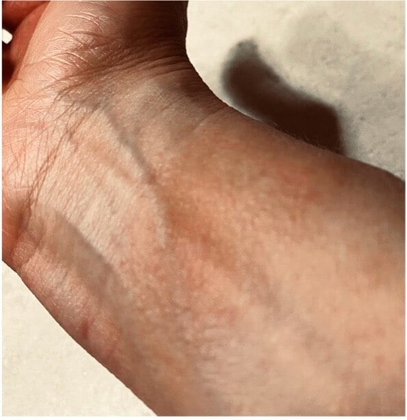 Preventing Dry Suit Gasket Rash and Eczema