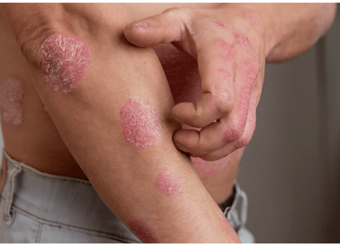 Psoriasis Awareness Month: How Manuka Honey & Manuka Oil Can Help