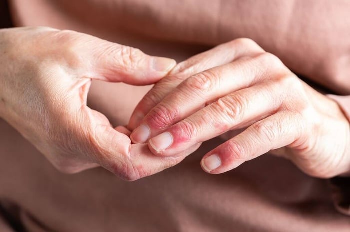 Manuka Honey Vs Eczema
