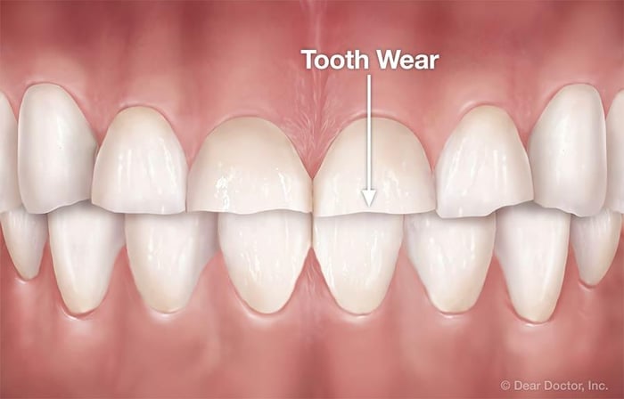 Worn Down Teeth?  Causes and Treatment