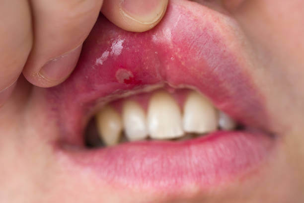 Are My Canker Sores From Grinding My Teeth?