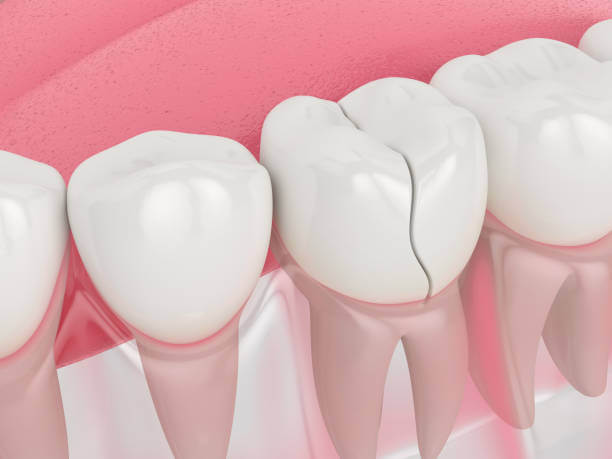 Top 5 Most Harmful Effects of Grinding Your Teeth at Night