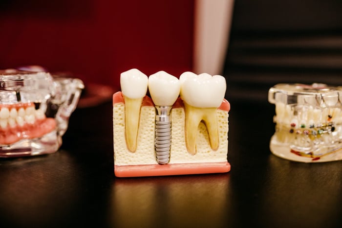 Wearing a Mouth Guard with Dental Implants