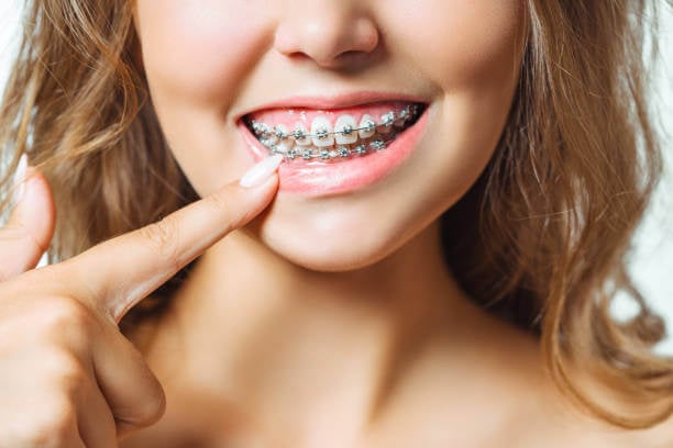 Can I Wear a Night Guard with Braces?