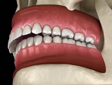 The Surprising Link Between Overbites and Teeth Grinding: What You Need to Know.