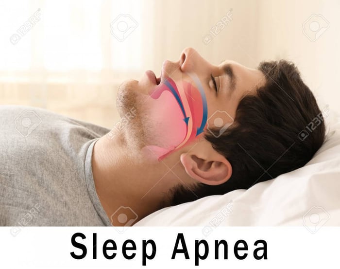 Can A Night Guard Help With Sleep Apnea?