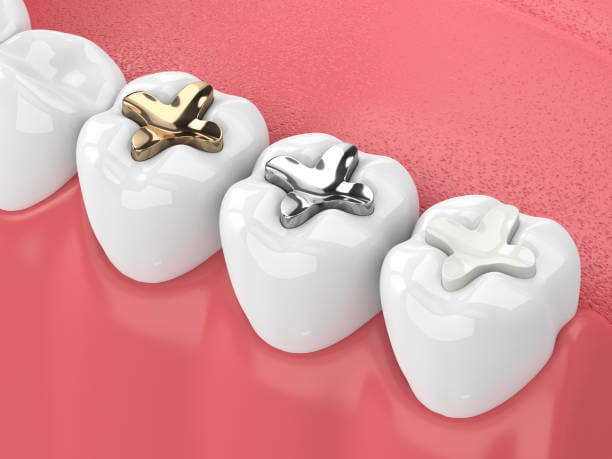 Teeth Grinding After Cavity Filling