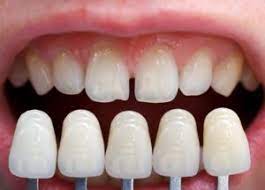 Can I Have Veneers If I Grind My Teeth?