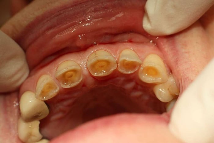 Grinding Teeth In Sleep:  Damaging Effects of Teeth Grinding