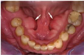 Understanding the Connection: Do Tori Bones Contribute to Nighttime Teeth Grinding?