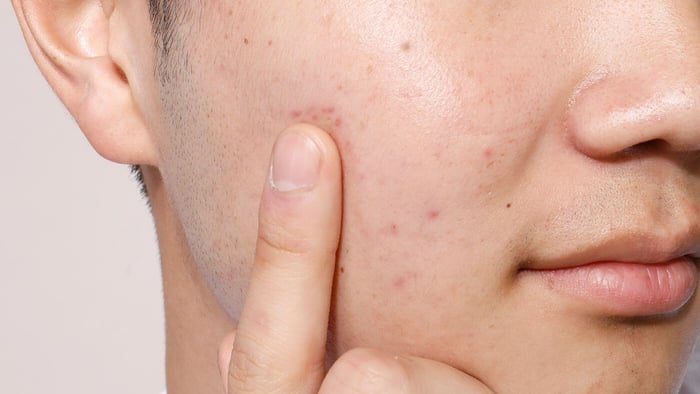5 Things not to do when you have acne