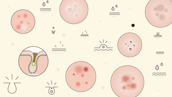 What makes pores look large?