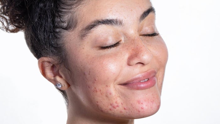 Why do post-blemish marks appear after acne?
