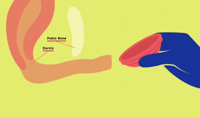 Menstrual disc insertion diagram showing pubic bone, cervix