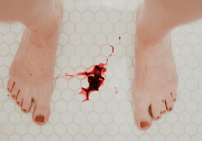 Explaining Endometriosis: No, Extremely Painful Periods Aren't Normal