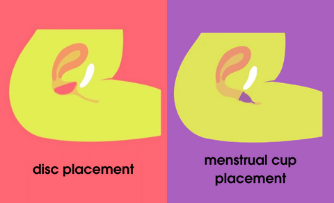 diagram showing the position of a menstrual disc compared to a menstrual cup