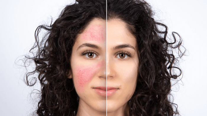 How to Keep Rosacea Under Control