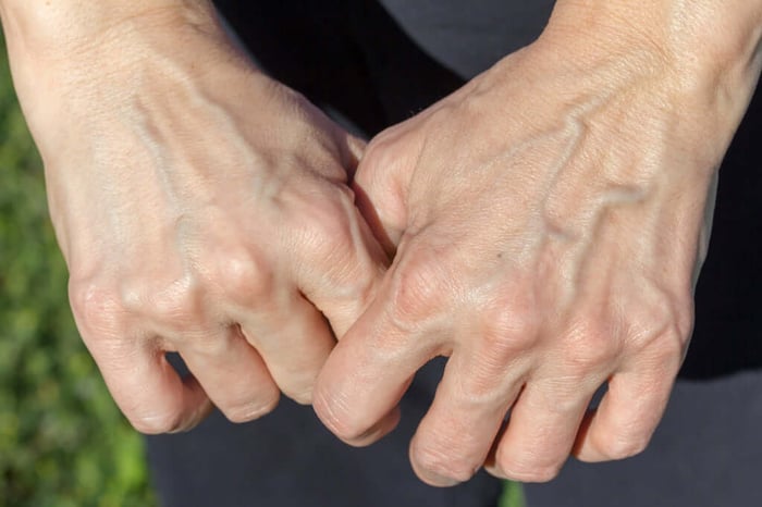 How to Eliminate Unsightly Hand Veins
