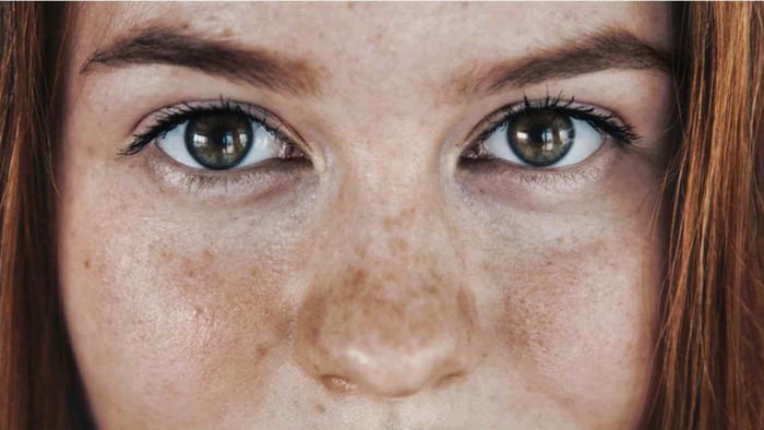 Dark Spots from Sun Damage? Here's What to Do
