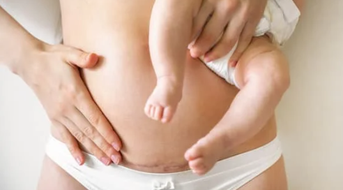 Nonsurgical Mommy Makeover: How to Get Your Pre-baby Bod Back