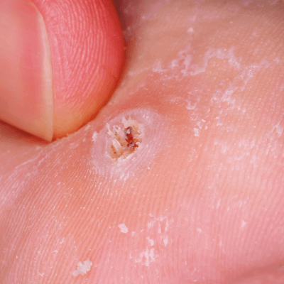 ตาปลาที่เท้า