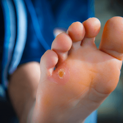 ตาปลาที่เท้า