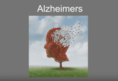 Micelle Curcumin vs Alzheimer