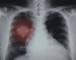 Lung Cancer Battled By Resveratrol and Curcumin Combo