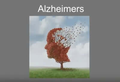 Micelle Curcumin vs Alzheimer