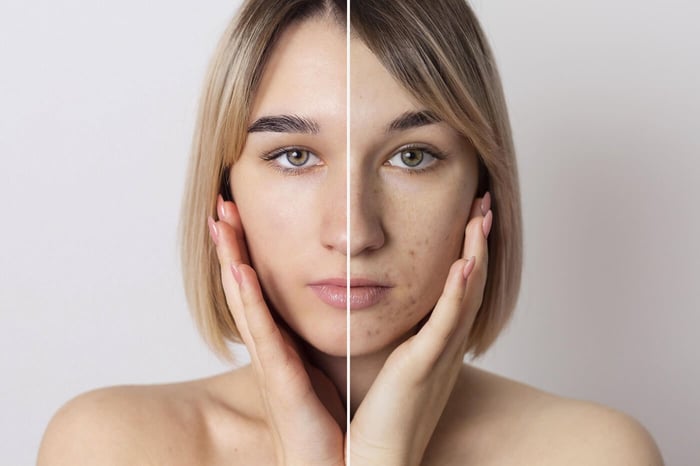 Causas del Acné y tratamiento natural