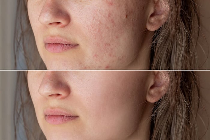 Root Causes of Skin Breakouts