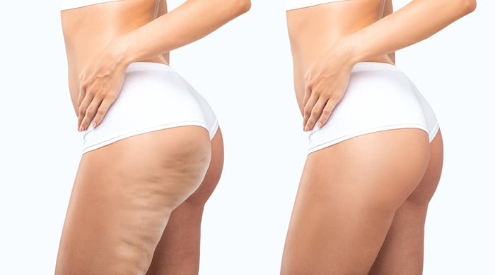 Why do some women get cellulite and others don’t?