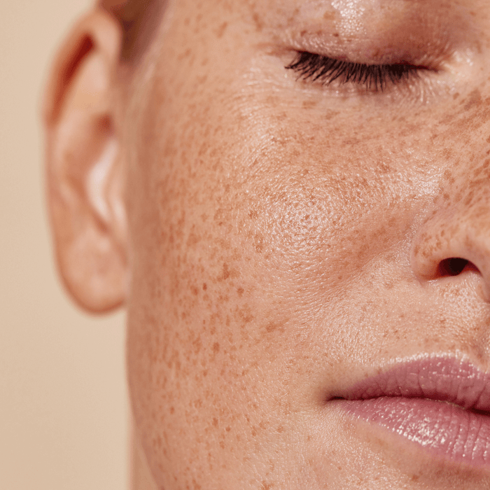 Hyperpigmentation and Summer