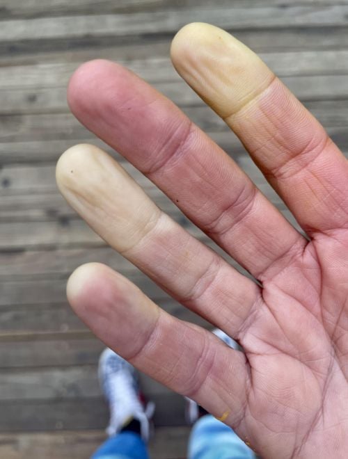 Hand showing Raynaud’s flare-up with pale and purple fingertips.