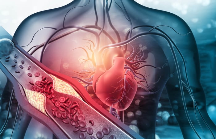 High Blood Pressure: What It Is and How to Lower It