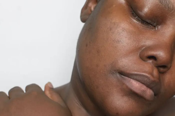 Best Product For Hyperpigmentation On Black Skin