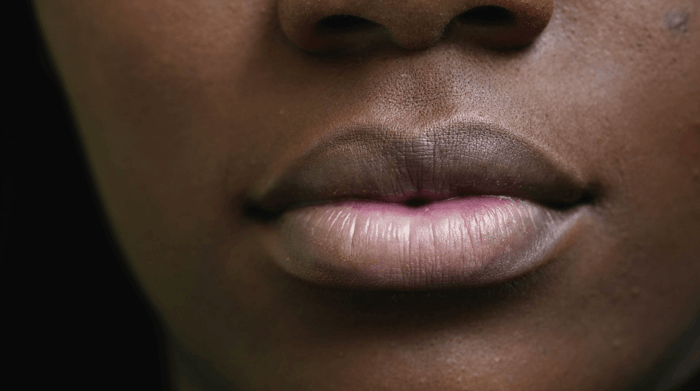 Hyperpigmentation Around Mouth Treatment: Best Solutions