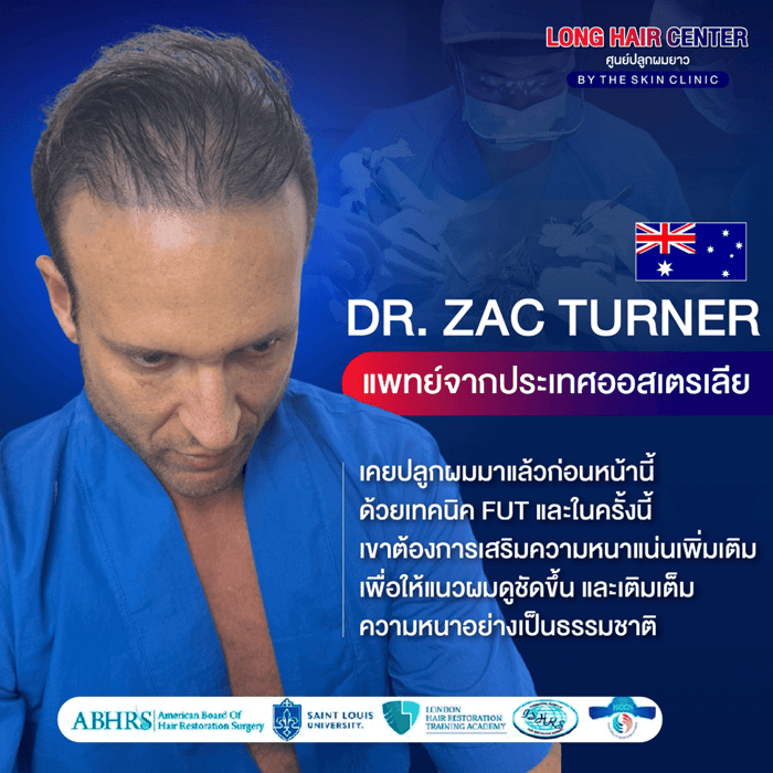เคสจริง! แพทย์จากออสเตรเลียบินตรงมาปลูกผมกับหมอท๊อป ด้วยเทคนิค Long Hair x ALMI Nano Fat