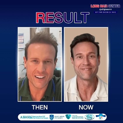 เคสจริง! แพทย์จากออสเตรเลียบินตรงมาปลูกผมกับหมอท๊อป ด้วยเทคนิค Long Hair x ALMI Nano Fat