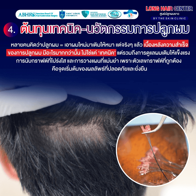 ปลูกผมราคาถูก vs ปลูกผมราคาแพง ต่างกันยังไง? เลือกแบบไหนไม่พลาด