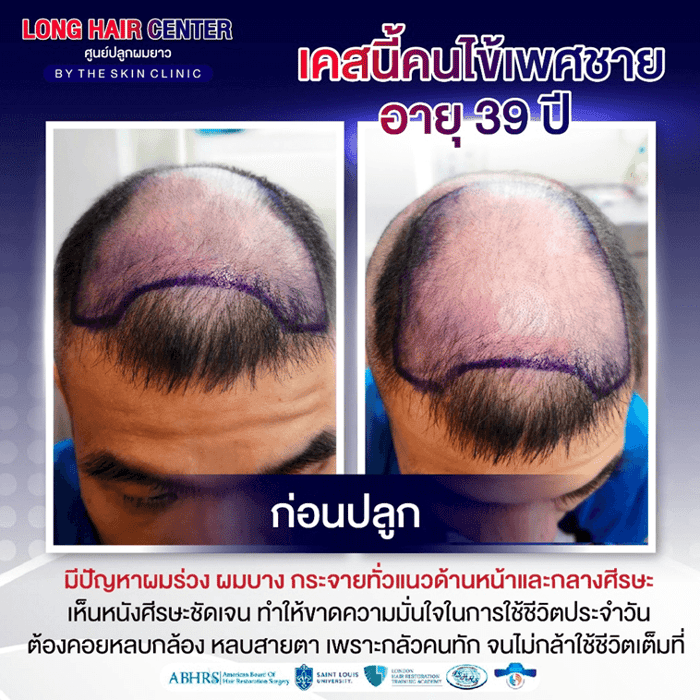 รีวิวปลูกผม: ปลูกผมผู้ชาย กู้คืนความมั่นใจด้วย เทคนิค Short Hair x ALMI Nano Fat