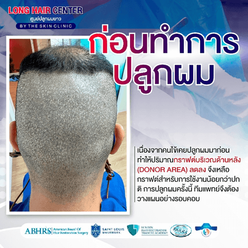 รีวิวปลูกผม: ปลูกผมผู้ชาย กู้คืนความมั่นใจด้วย เทคนิค Short Hair x ALMI Nano Fat