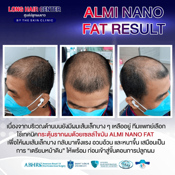 รีวิวปลูกผม: ปลูกผมผู้ชาย กู้คืนความมั่นใจด้วย เทคนิค Short Hair x ALMI Nano Fat